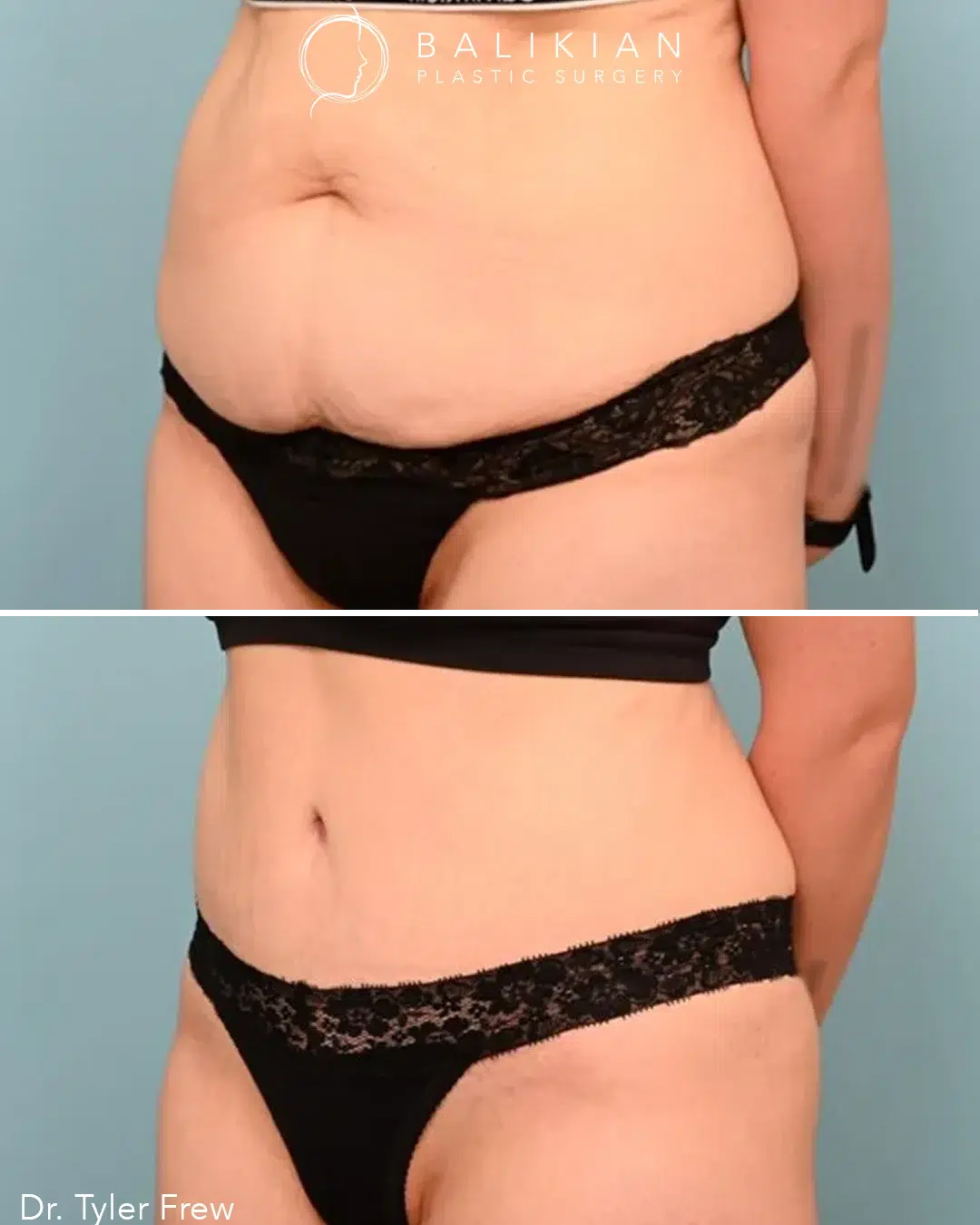 Before: sagging lower abdomen with skin folds. After: smooth, flat stomach with defined waist.