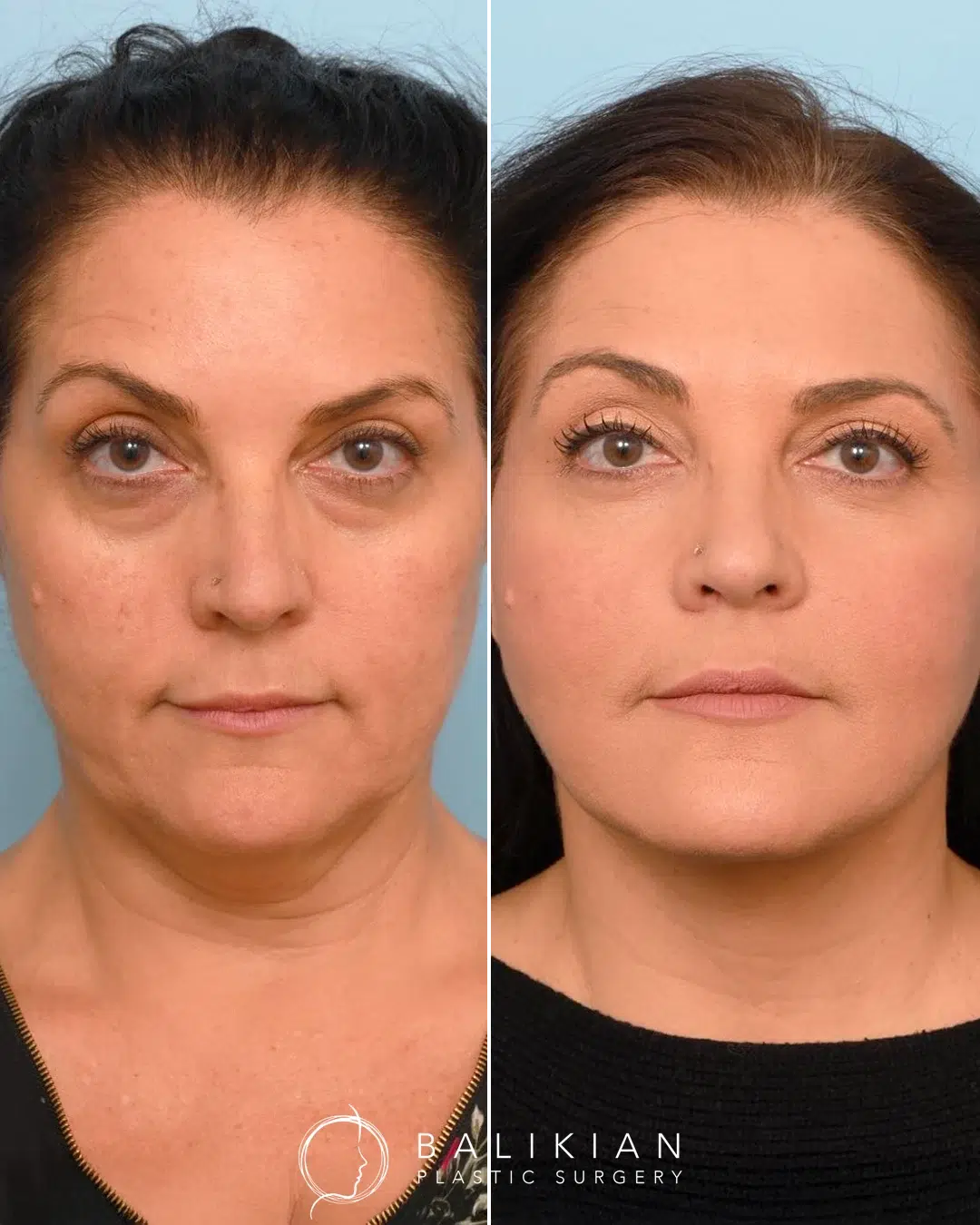 Facelift and neck lift before and after front view of a woman with improved jawline contour, lifted cheeks, and a more youthful expression.