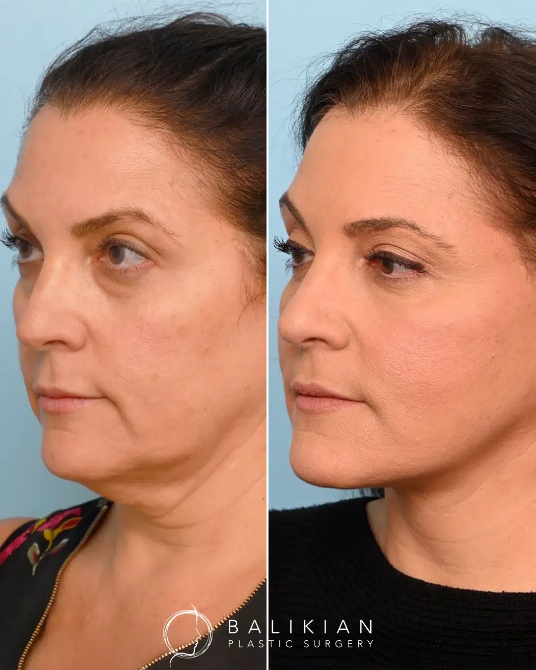 Facelift and neck lift before and after left oblique view showing firmer chin, sculpted jawline, and smoother skin.