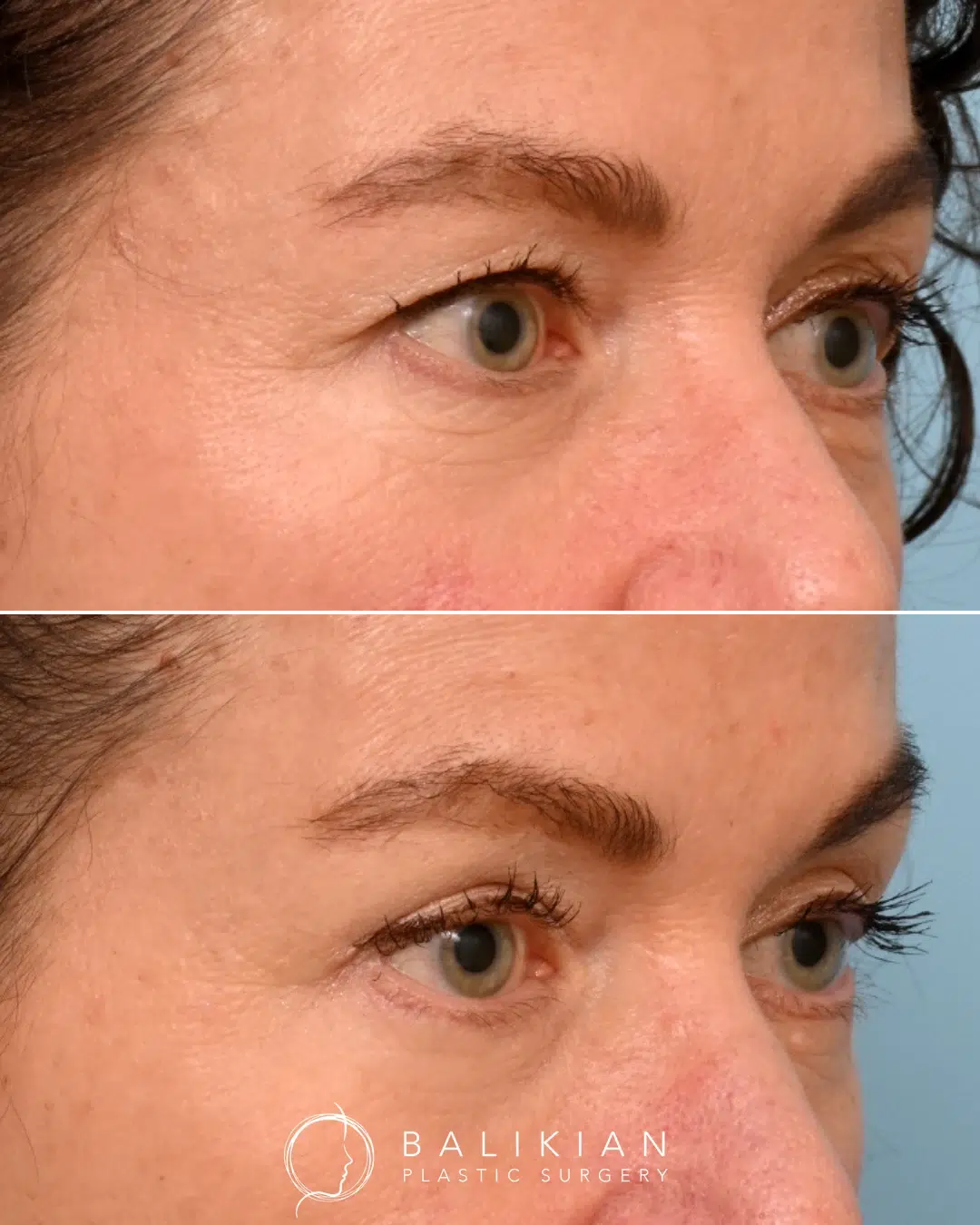 Female patient before and after upper and lower blepharoplasty, showing smoother eyelids and a brighter, refreshed eye appearance.