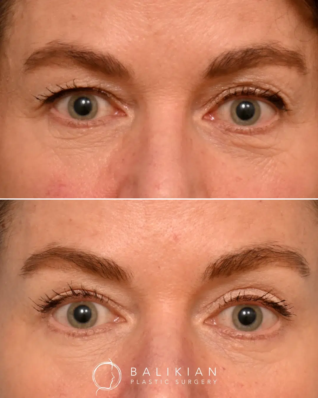 Close-up before and after of upper eyelid surgery, highlighting lifted lids and reduced excess skin.