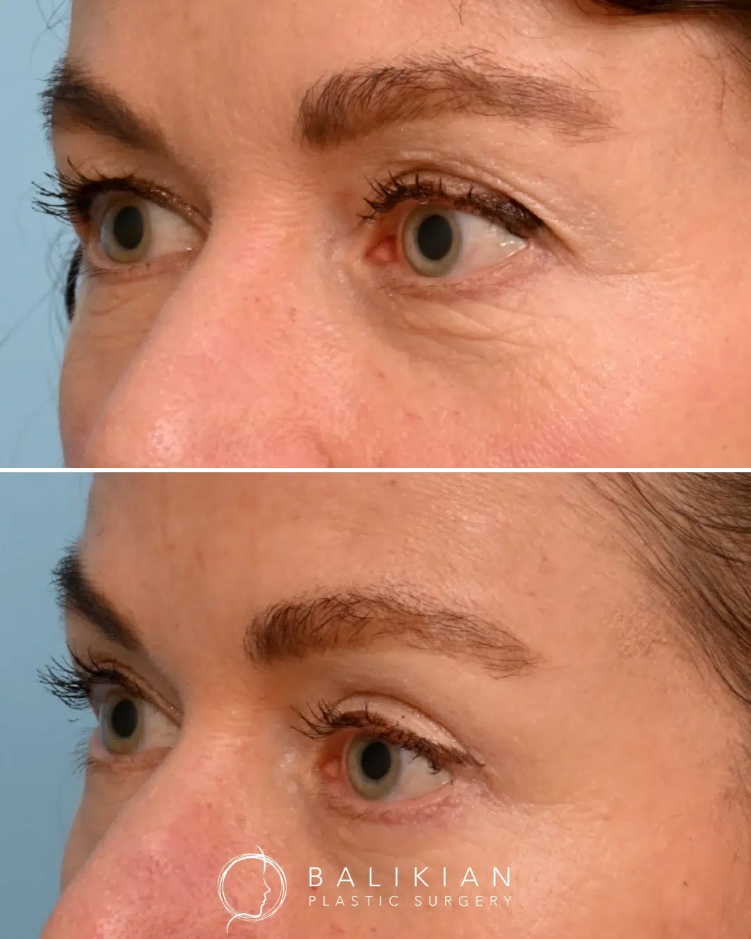 Lower blepharoplasty before and after, reducing puffiness and under-eye bags for a youthful, well-rested look.