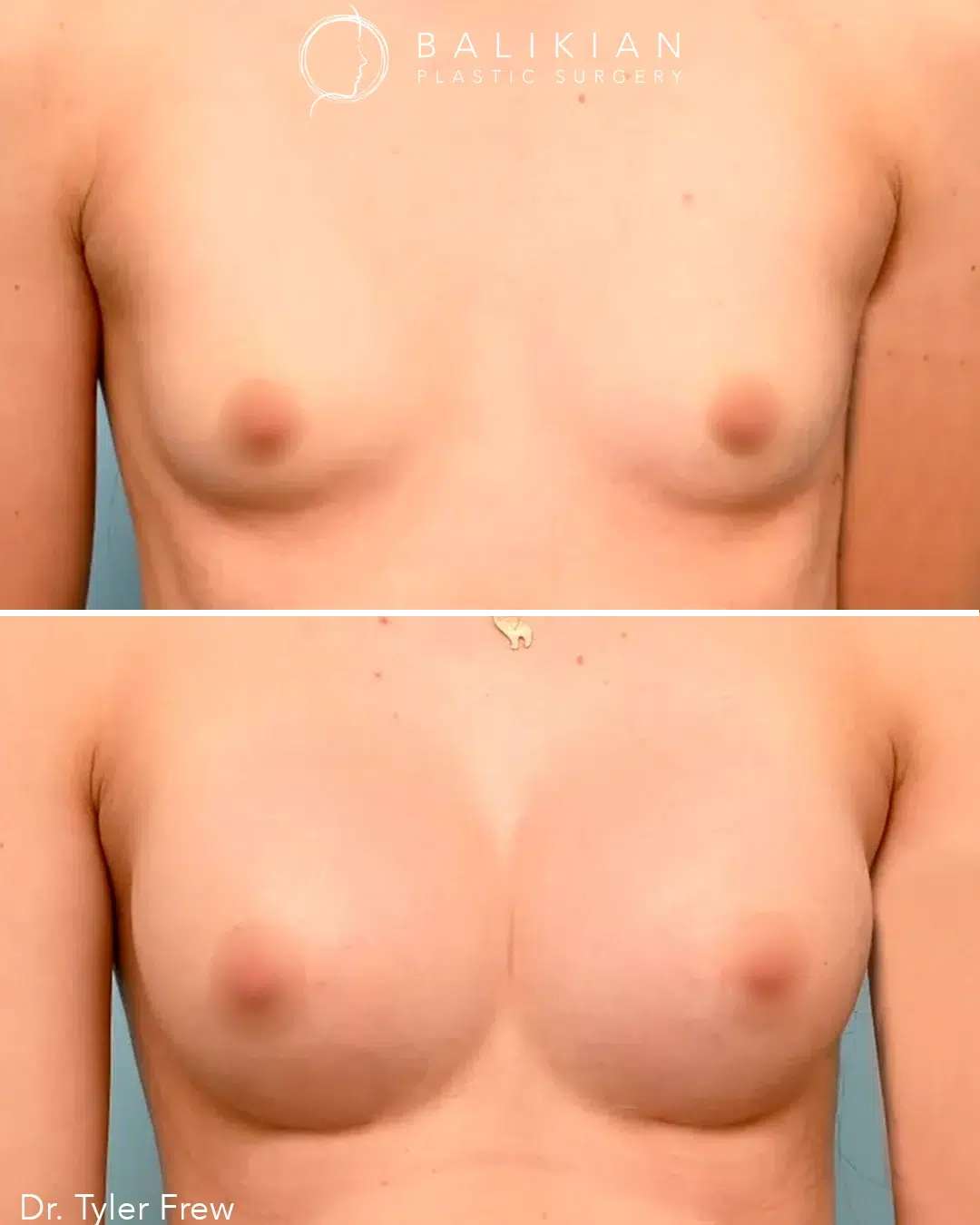 Before and after breast augmentation angled view. The after image reveals fuller upper pole volume, better balance between the chest and waist, and a smooth, natural transition at the breast crease.