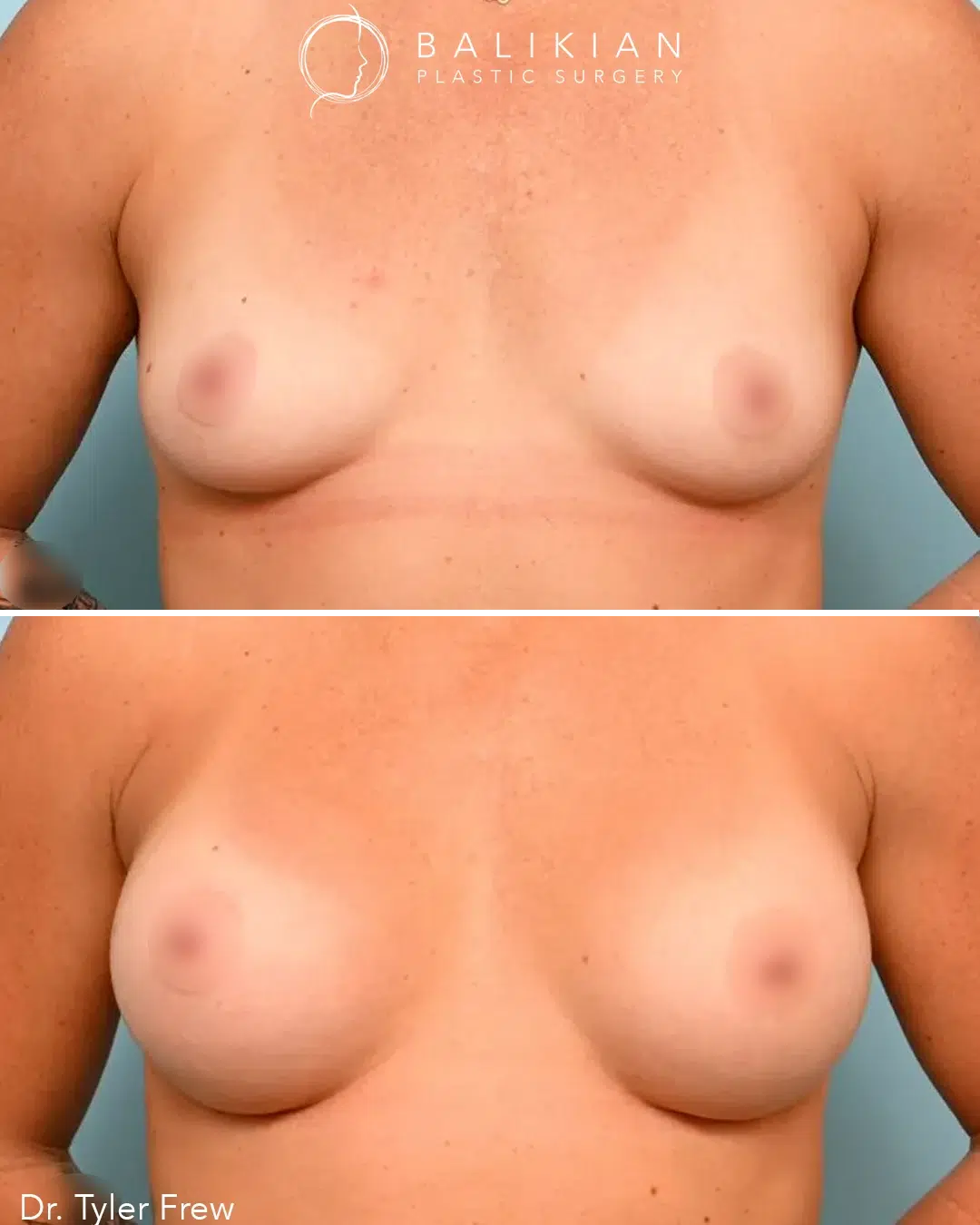 Front view before and after breast augmentation. The patient’s breasts appear larger, rounder, and more even in size after surgery, creating a proportionate and balanced silhouette.