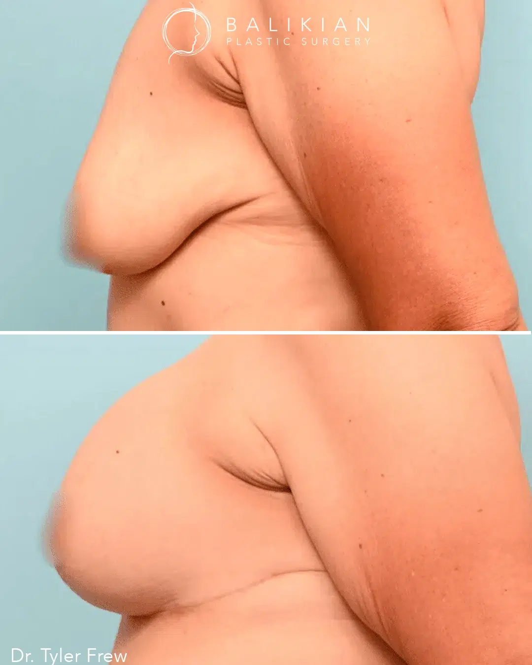 Before image shows breast sagging with downward projection. After image shows lifted breast with firmer contour and improved forward projection.