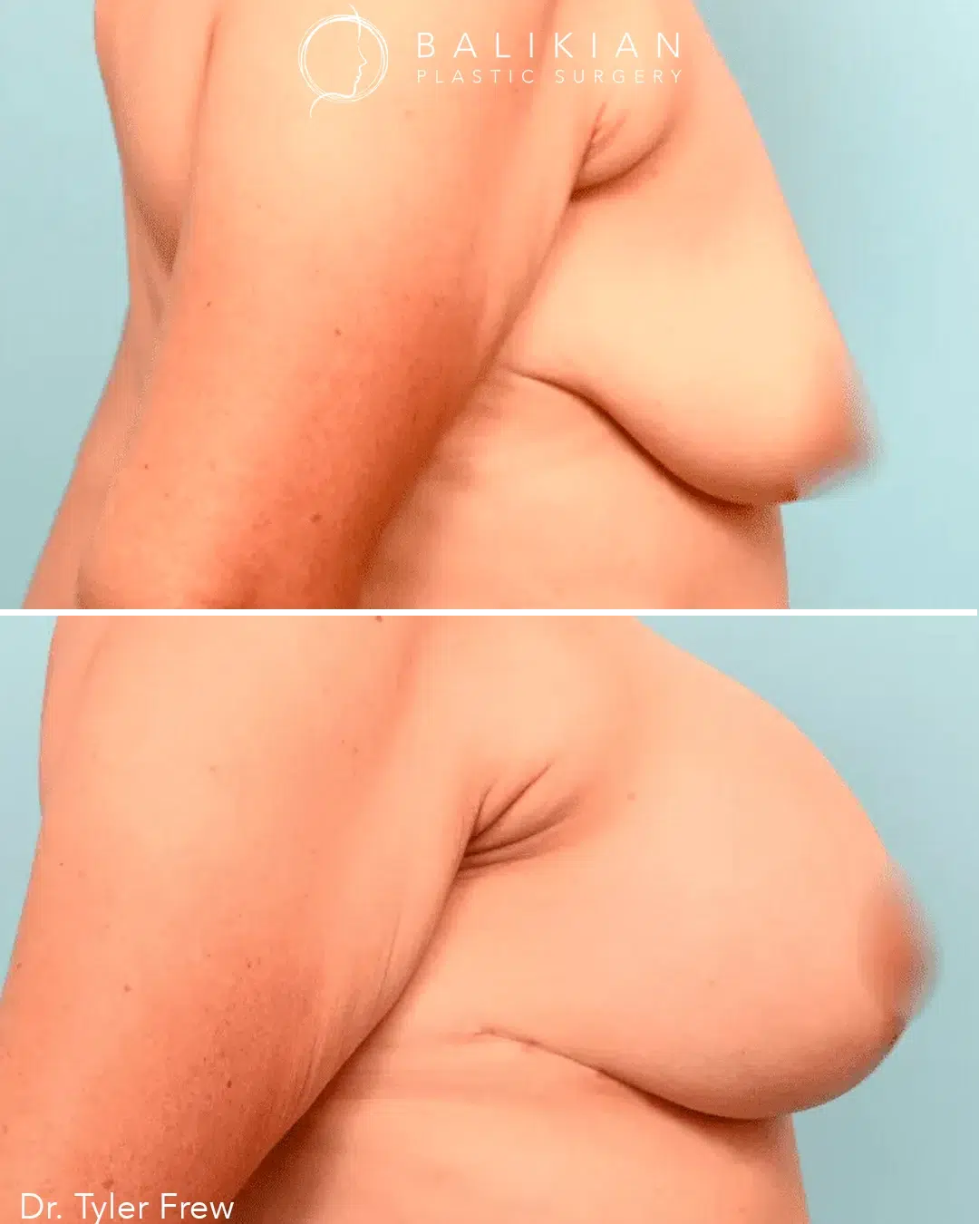 Before image shows breast sagging with reduced upper pole fullness. After image shows lifted breast with enhanced upper fullness and higher nipple position.