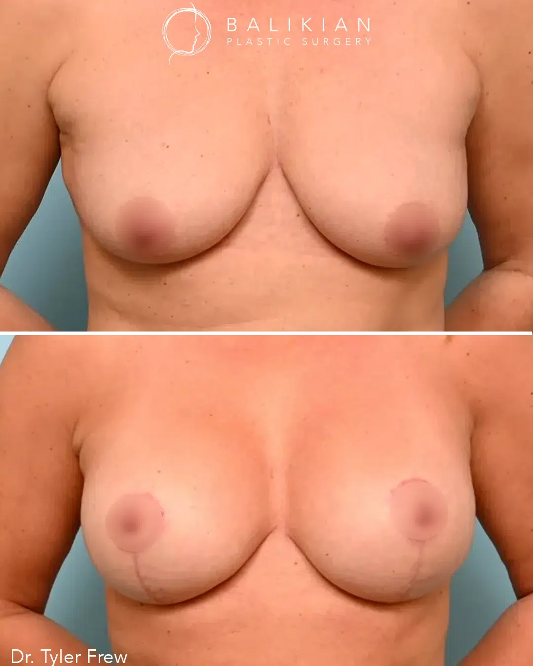 Before image shows sagging breasts with nipples positioned downward. After image shows symmetrical, lifted breasts with rounder shape, higher nipple placement, and improved firmness.