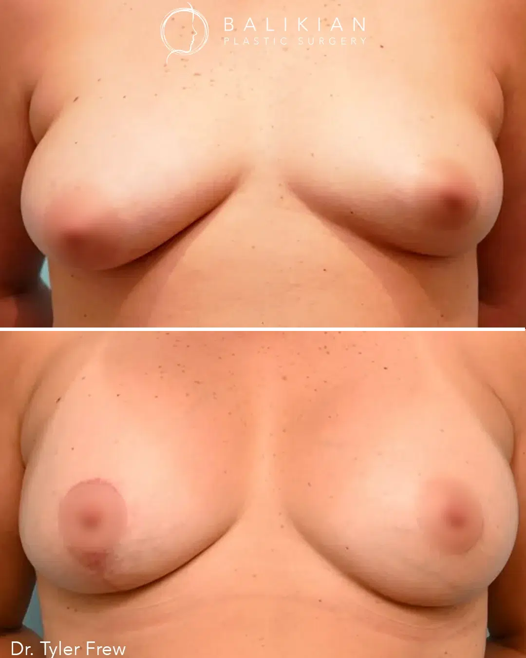 Front view before and after breast lift with Dr. Tyler Frew at Balikian Plastic Surgery, showing symmetrical, lifted breasts with natural-looking volume and improved firmness.