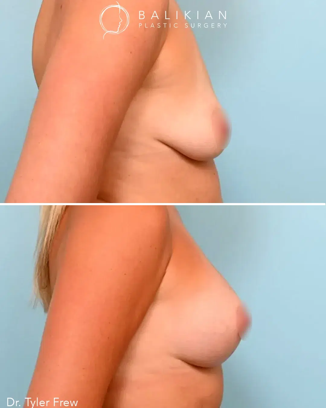 Side view before-and-after photo of a breast lift with implants, highlighting improved projection and perkier breast shape.