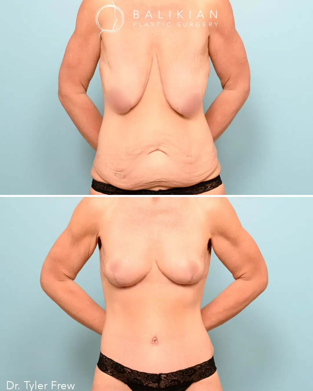 The combined procedures improved comfort, posture, and silhouette for a more confident appearance.