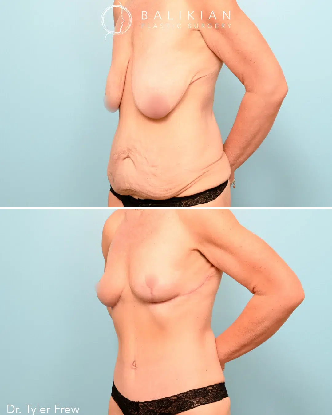 This patient’s results showcase a lighter chest, a smoother abdomen, and a more balanced overall figure.