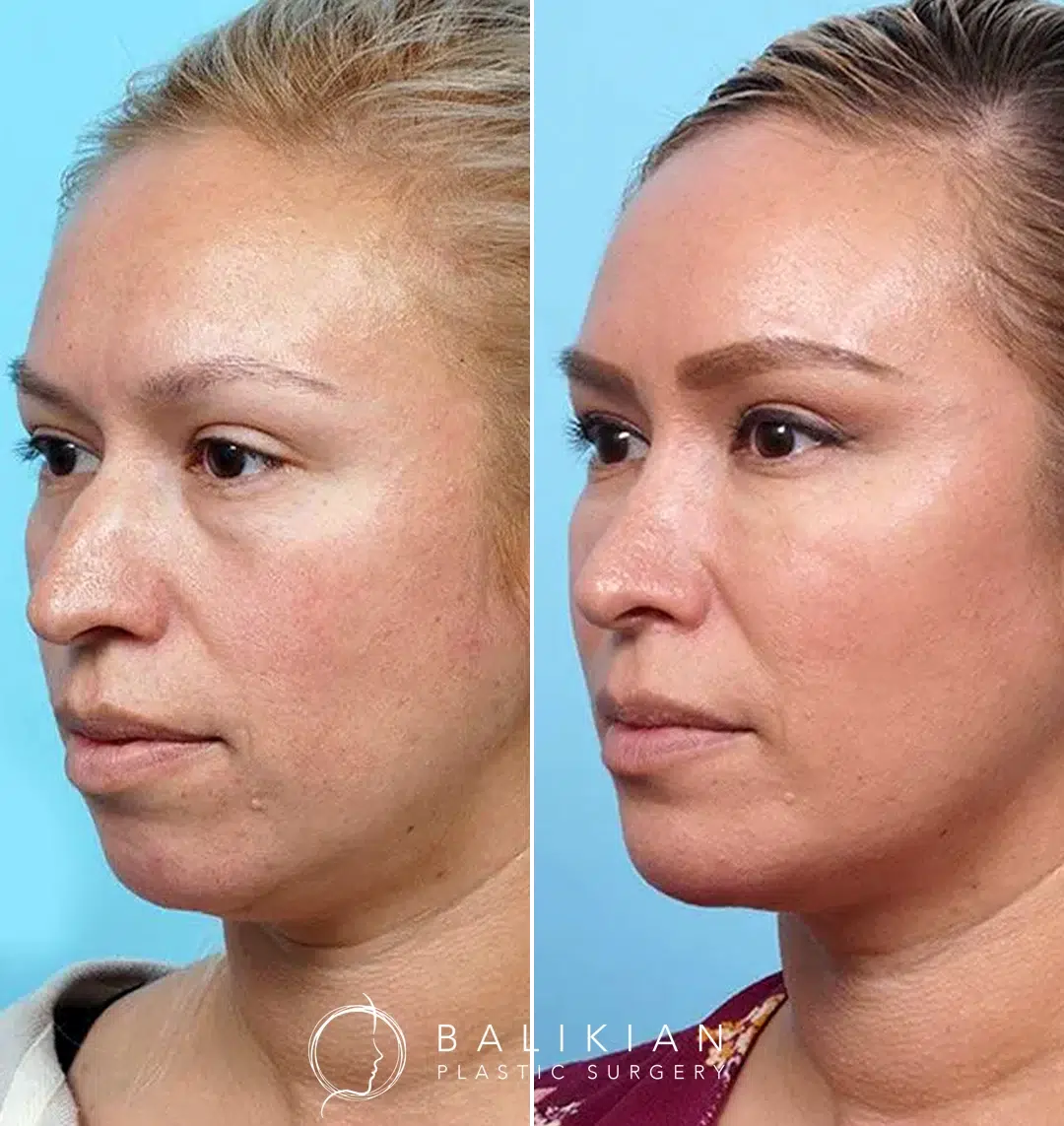 Before and after photo of chin augmentation with implant, showing improved jawline definition and balanced facial profile.