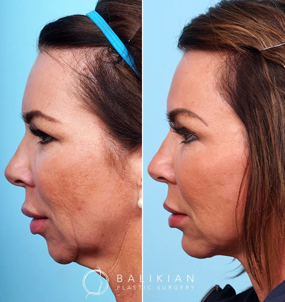 Chin implant augmentation before and after results, highlighting enhanced chin projection and facial harmony.