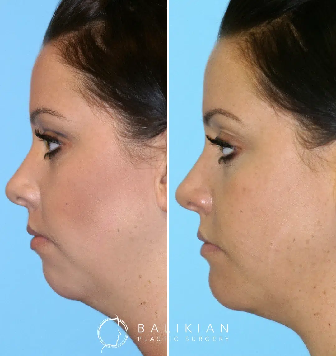 Before and after chin implant surgery performed by Dr. Richard Balikian, improving profile balance and jawline contour.