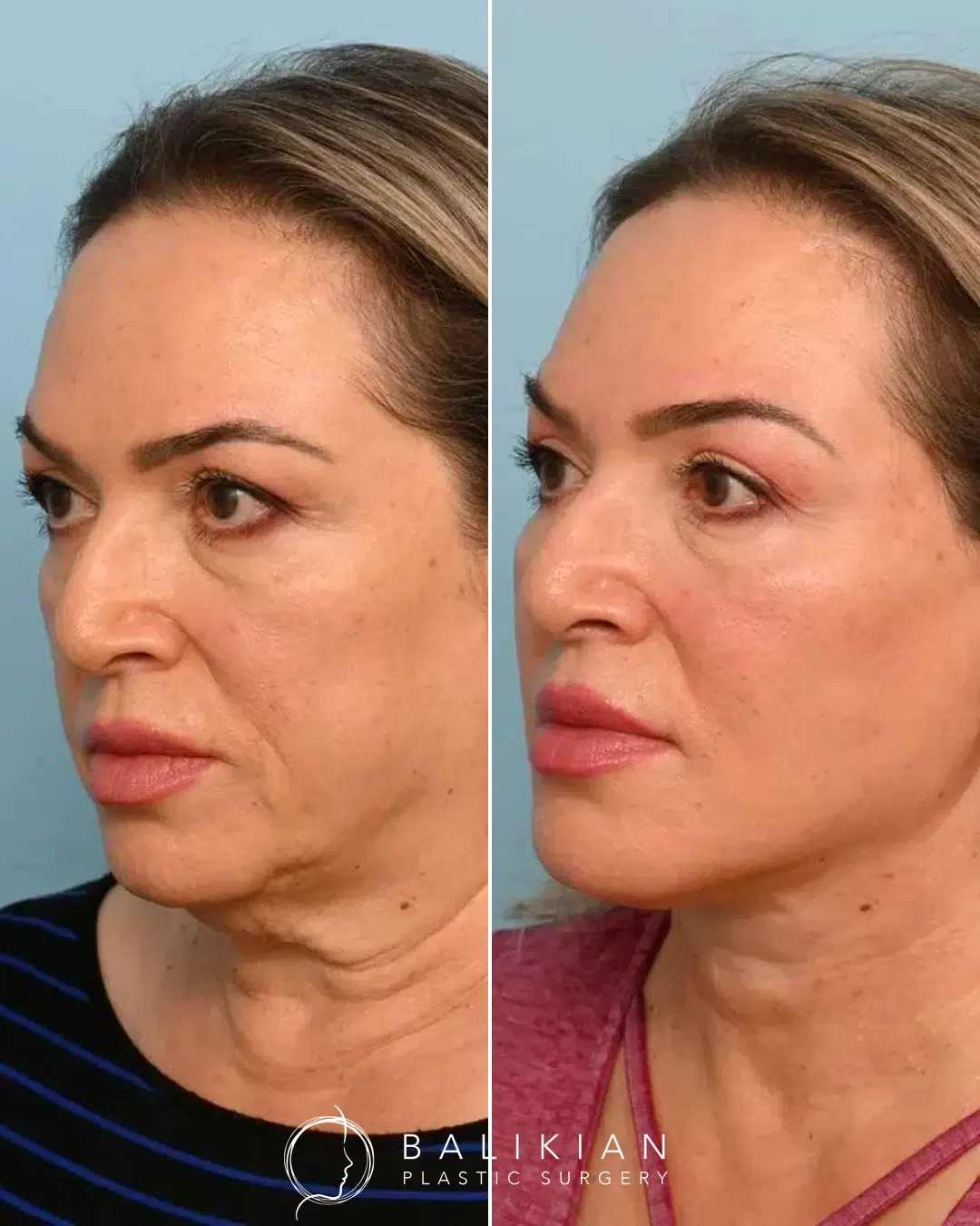 Before and after deep plane facelift angled view showing correction of jowls, firmer neckline, and natural rejuvenation around the lower face.