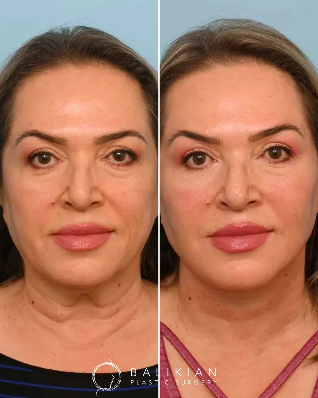 Before and after deep plane facelift of a woman. Noticeable tightening of the jawline, smoother neck contour, and lifted midface creating a more youthful, refreshed appearance.