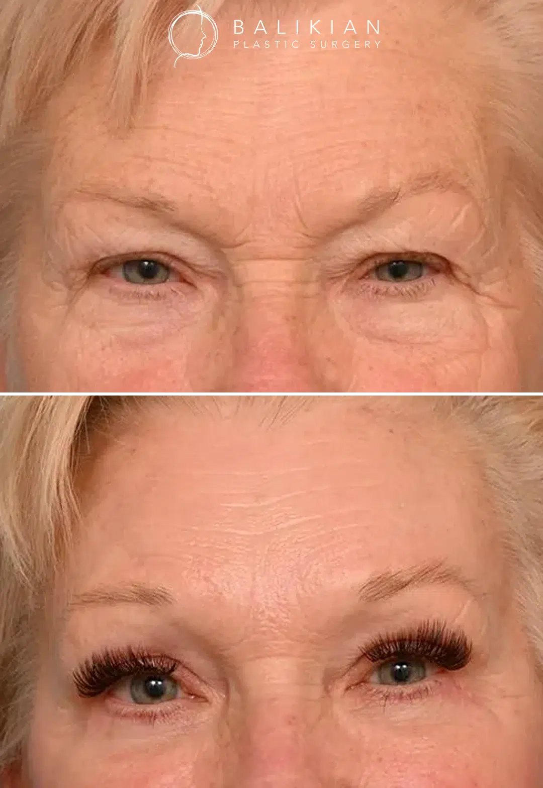 Before and after frontal view of an older woman following brow lift surgery, showing lifted brow position, smoother forehead, and brighter eyes.