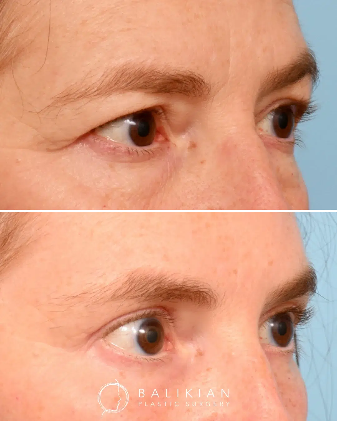 Female patient before and after blepharoplasty, with improved upper lid contour and natural-looking rejuvenation.