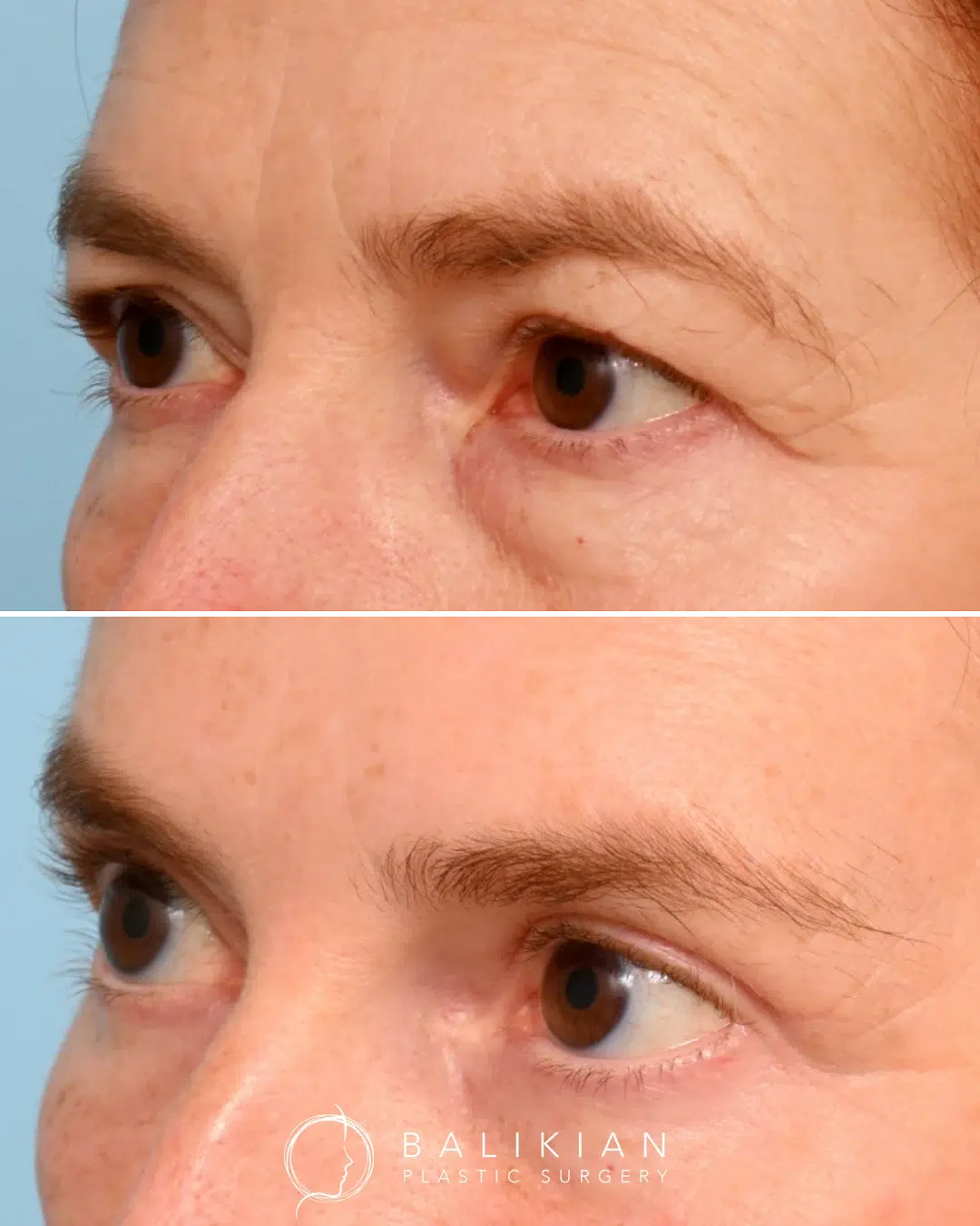 Upper and lower blepharoplasty results showing smoother eyelids and diminished under-eye hollows.