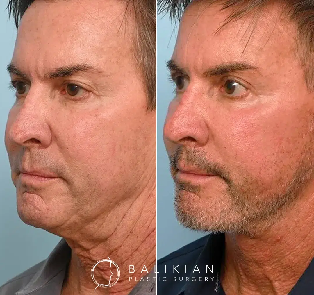 Side view before-and-after photos of a middle-aged man after facelift surgery, highlighting improved jawline definition and smoother facial contours.
