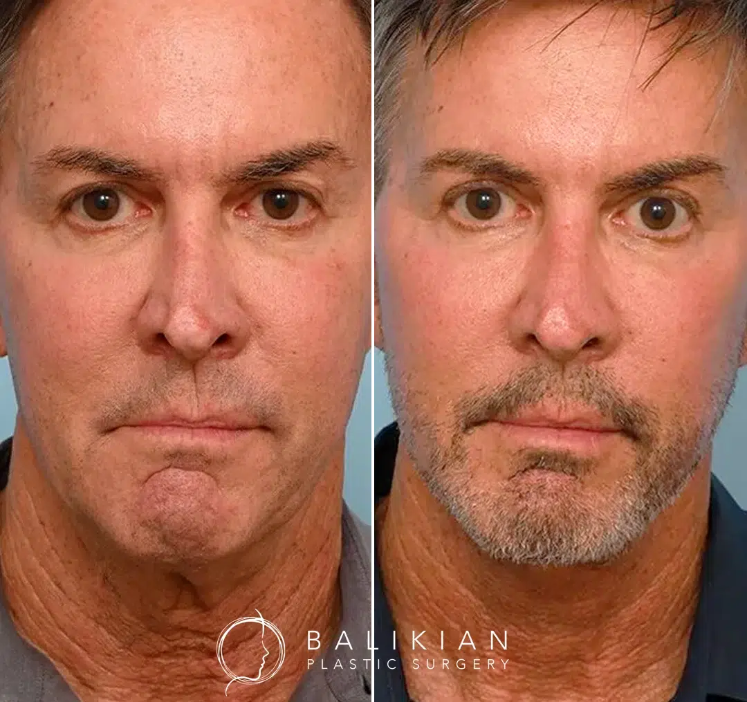 Front-facing before-and-after photos of a middle-aged man following a facelift, showing lifted features, firmer skin, and a more youthful look.