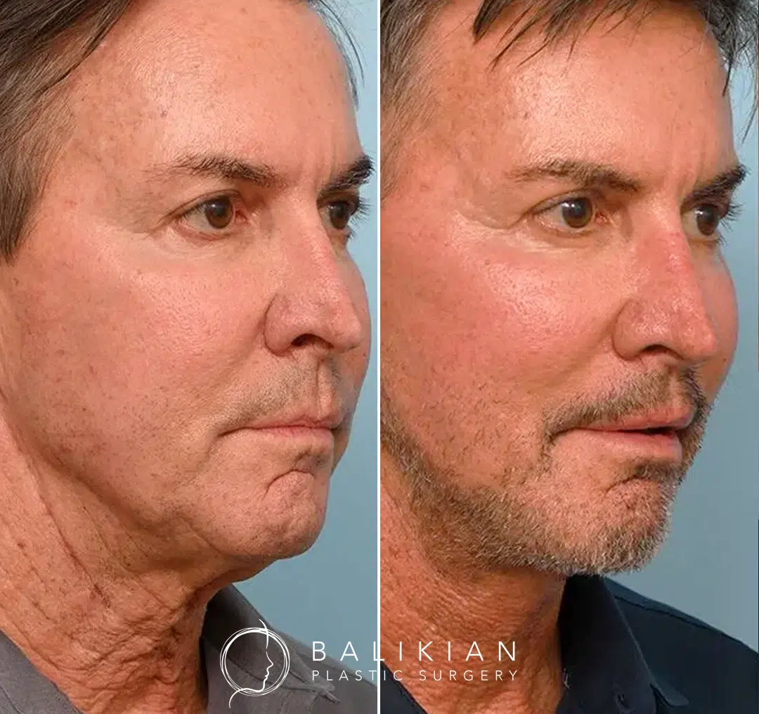 Angled before-and-after photos of a middle-aged man after facelift surgery, with visible tightening in the neck and jawline and a rejuvenated facial profile.
