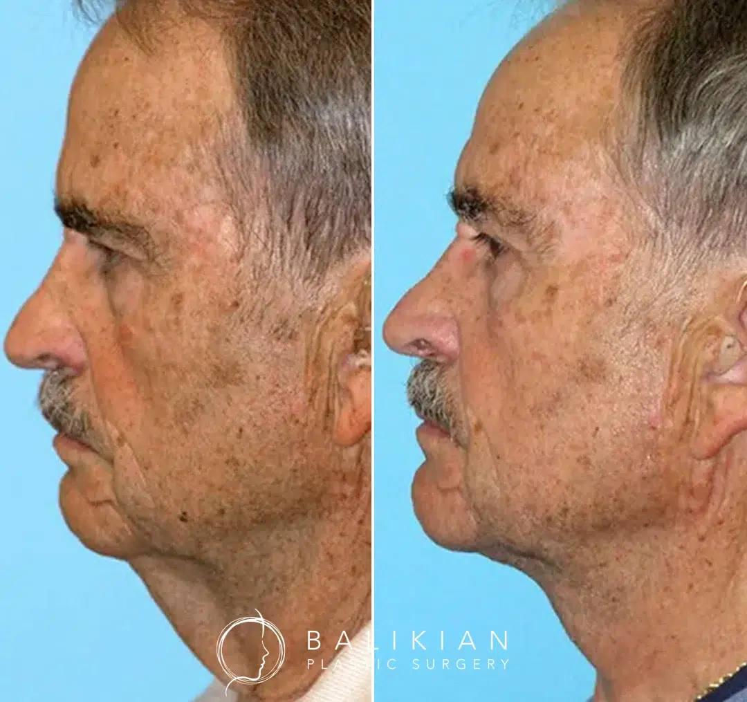 Side view before-and-after photos of an older man following a facelift, with a more defined neck and jawline and reduced sagging in the lower face.