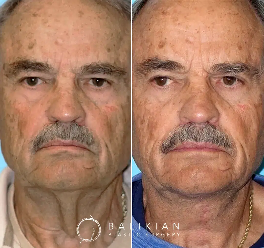 Front-facing before-and-after photos of an older man after facelift surgery, showing tightened skin, reduced facial sagging, and a refreshed, natural appearance.
