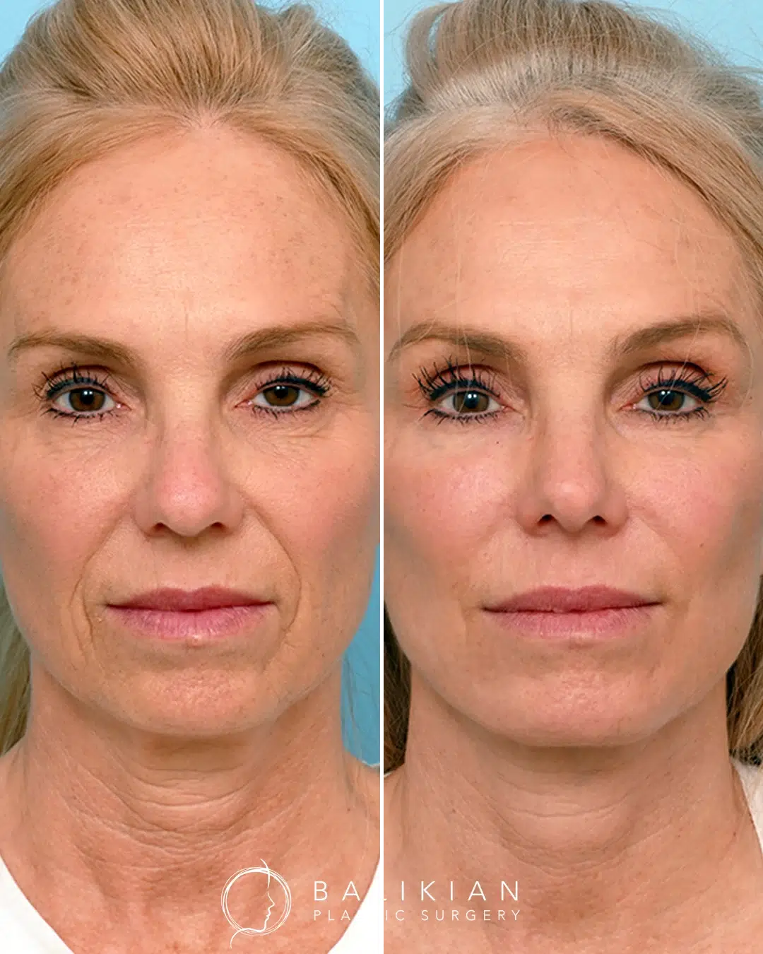 Before and after facial fat transfer with deep plane facelift, showing restored cheek volume, smoother under-eye hollows, and improved facial contours.