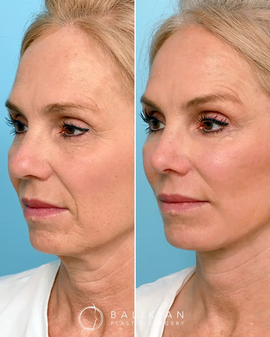 Female patient before and after facial fat transfer and neck lift, highlighting fuller cheeks, refined jawline, and natural midface rejuvenation.