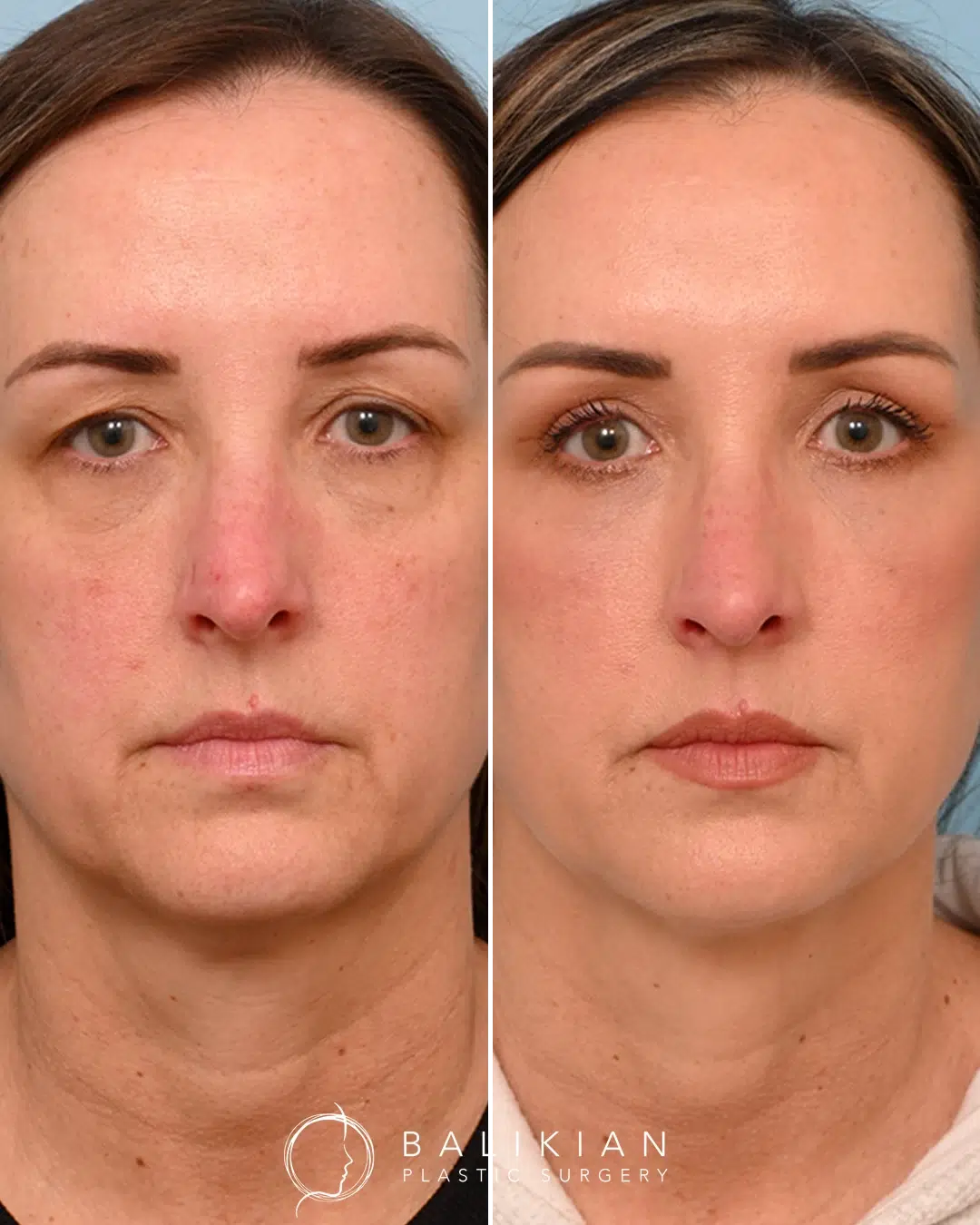 Before and after facial fat grafting, demonstrating enhanced facial balance and softened nasolabial folds.