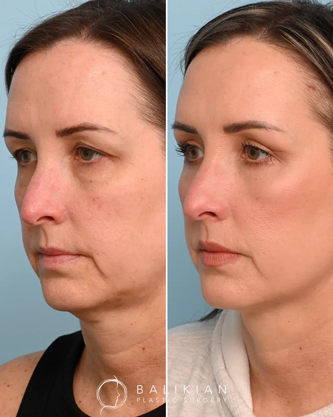 Facial fat transfer before and after with eyelid surgery, showing brighter, more youthful eyes and refreshed midface volume.