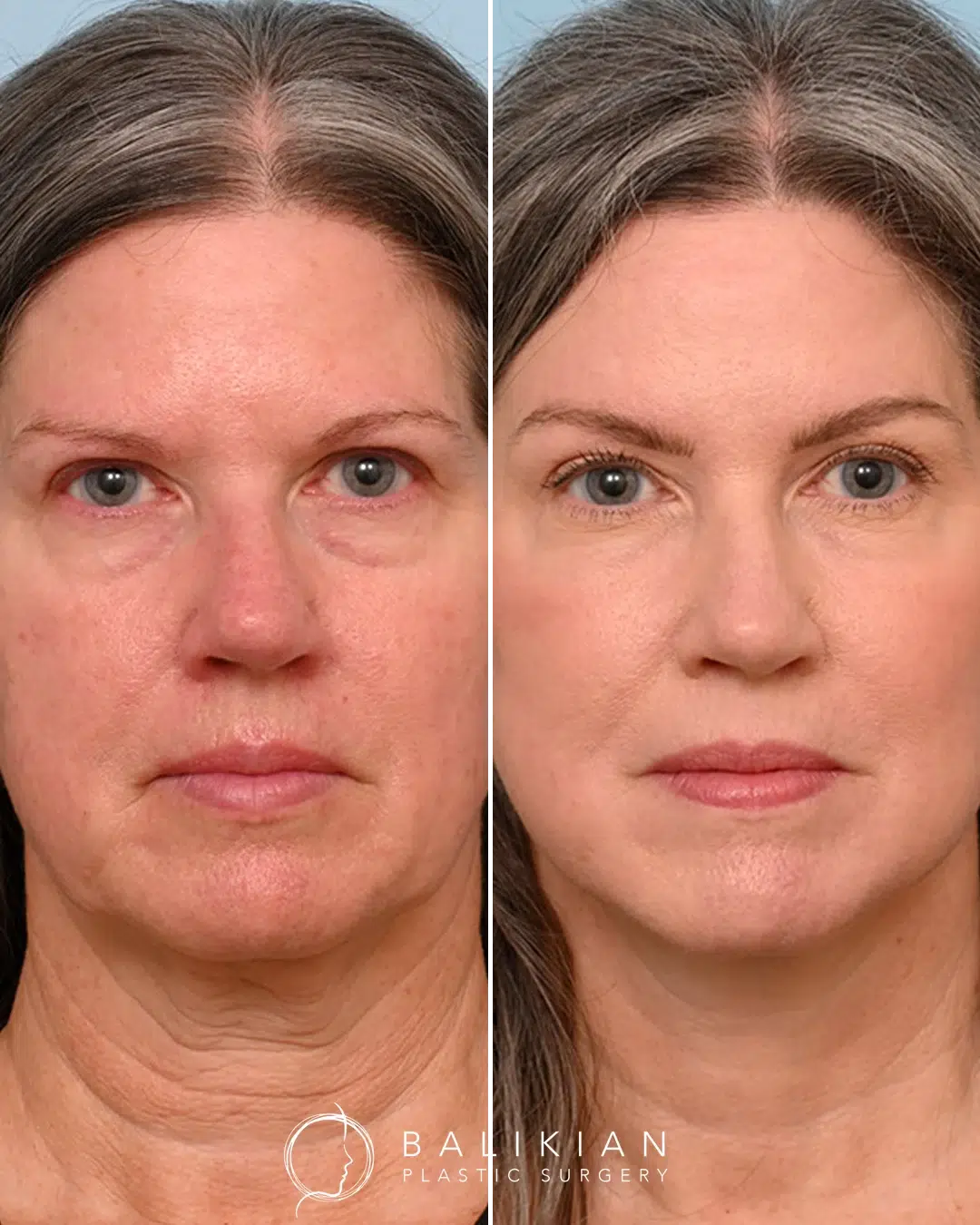 Before and after facial fat transfer with brow lift, illustrating lifted brows, restored upper face volume, and natural rejuvenation.