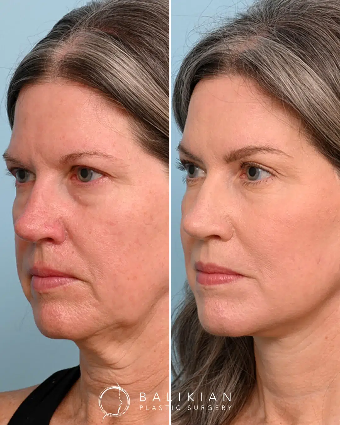 Facial fat transfer before and after with facelift and neck lift, creating smoother neck contour, elevated cheeks, and balanced profile.