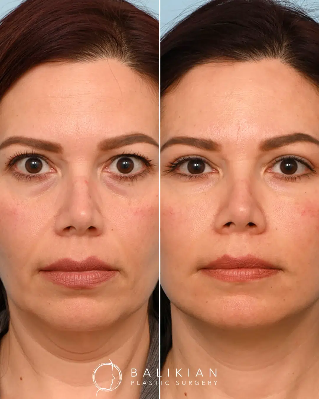Female patient before and after facial fat grafting, restoring youthful volume and softening deep facial lines.
