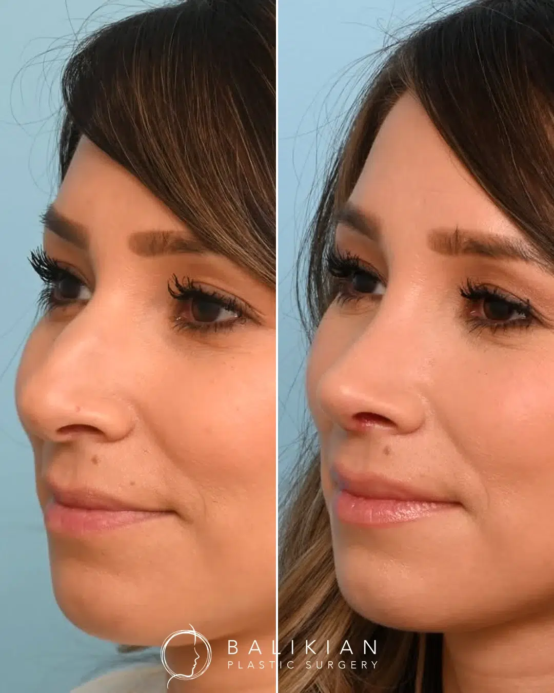 Rhinoplasty before and after, female oblique view right. Bridge straightened with a softer tip for balanced profile. Left is before, right is after.