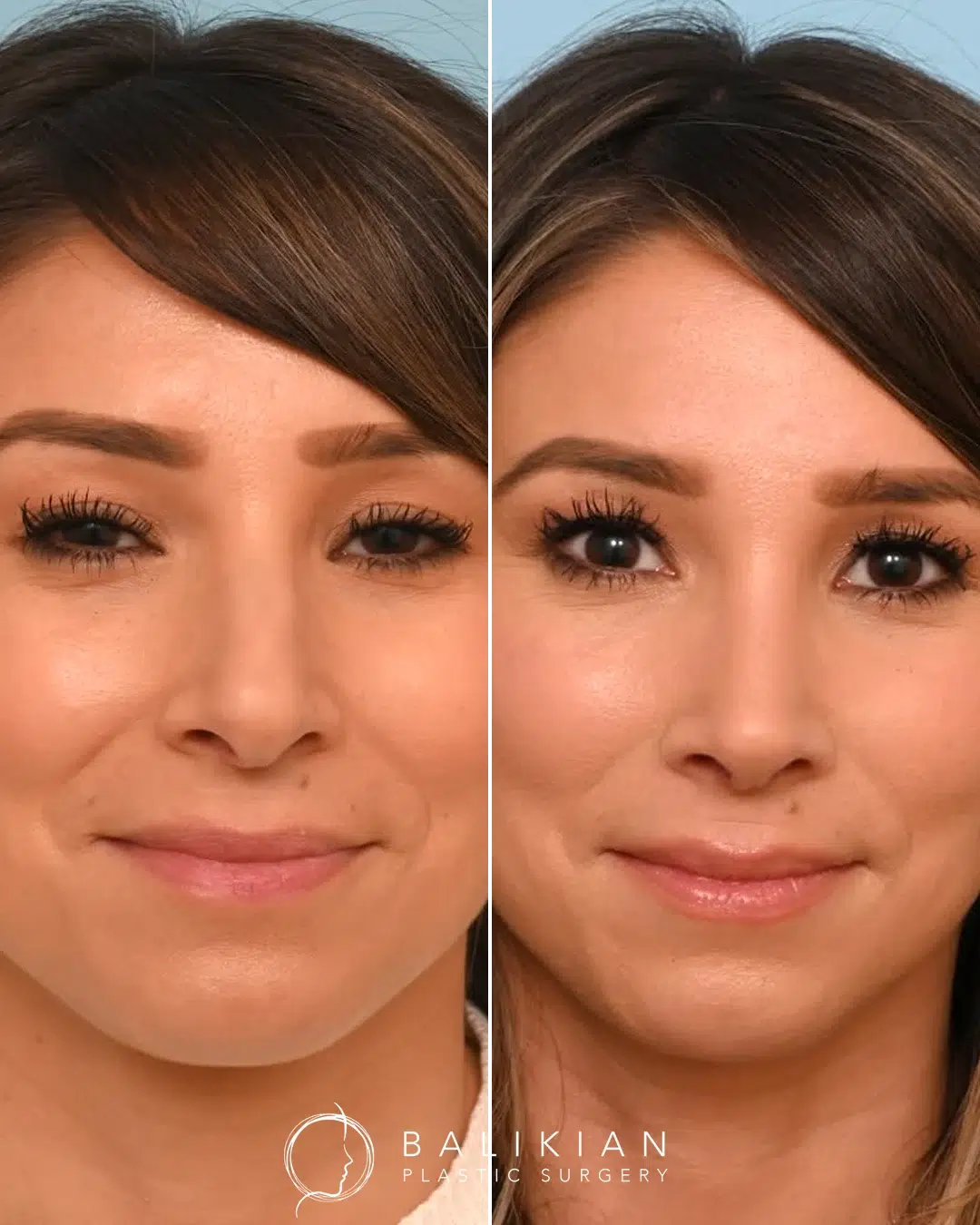 Rhinoplasty before and after, female front view. Straighter bridge and refined tip for a natural look. Left is before, right is after.