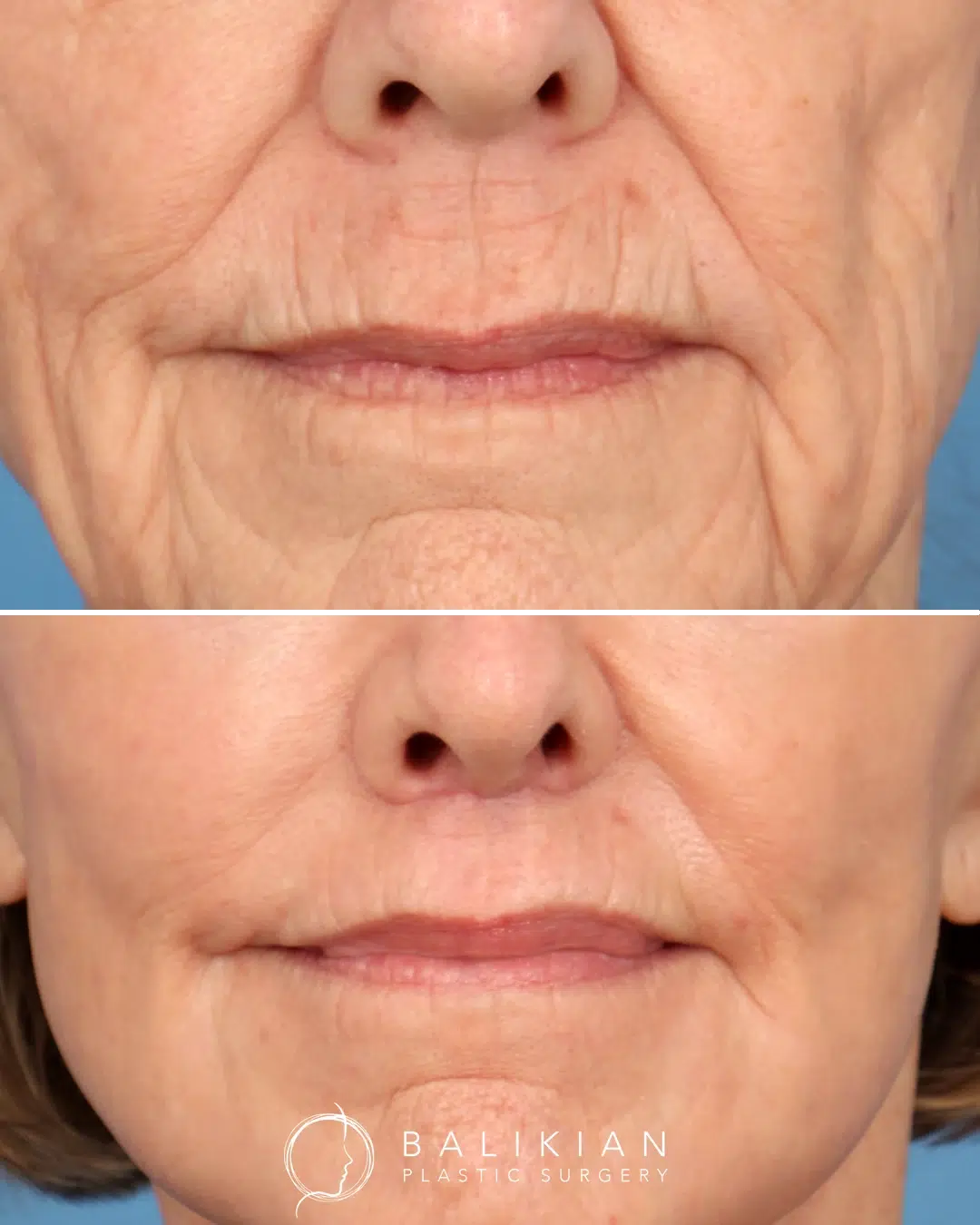 Close-up lip lift before and after photo showing reduced distance between nose and upper lip, smoother skin around the mouth, and improved lip definition.