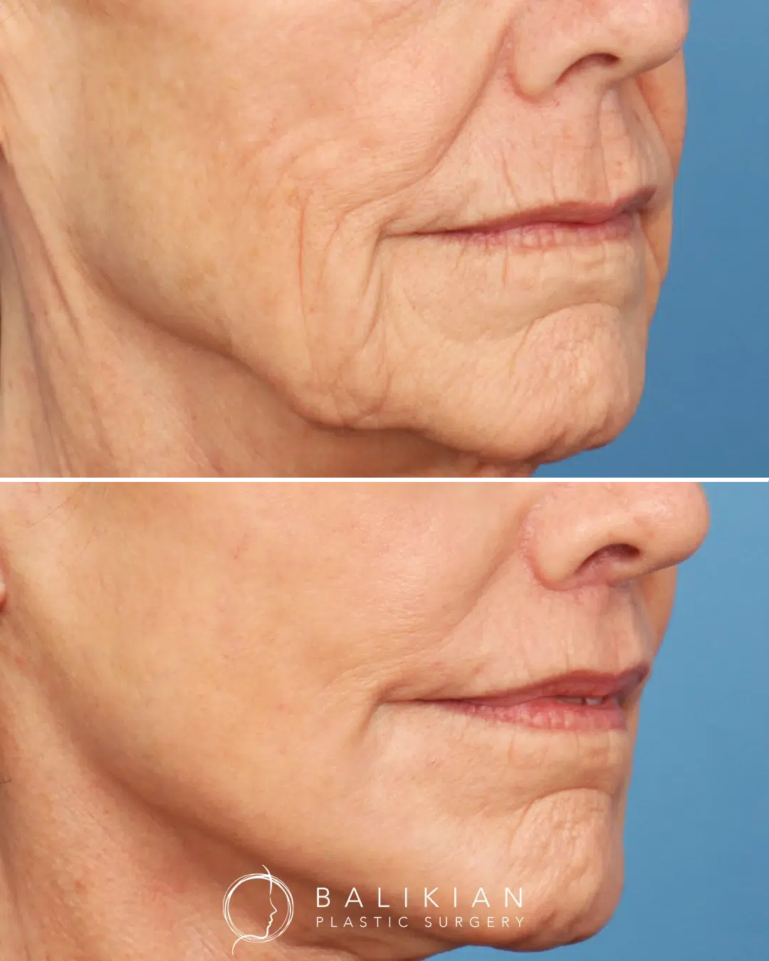 Upper lip lift before and after side view highlighting enhanced lip contour, shorter philtrum, and a more youthful smile profile.
