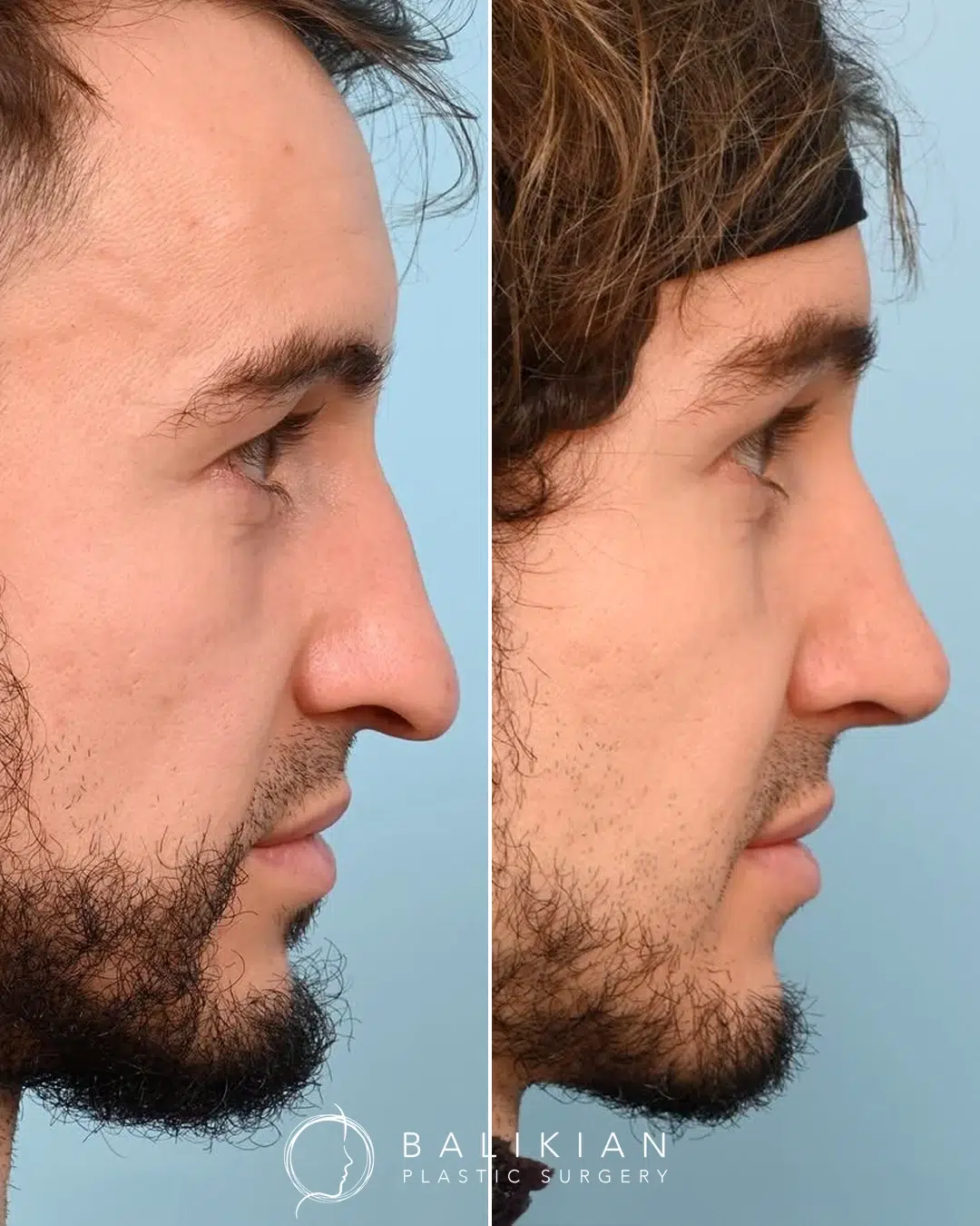 Rhinoplasty before and after, male side profile. Dorsal hump smoothed and tip refined for a straighter nose. Left is before, right is after.