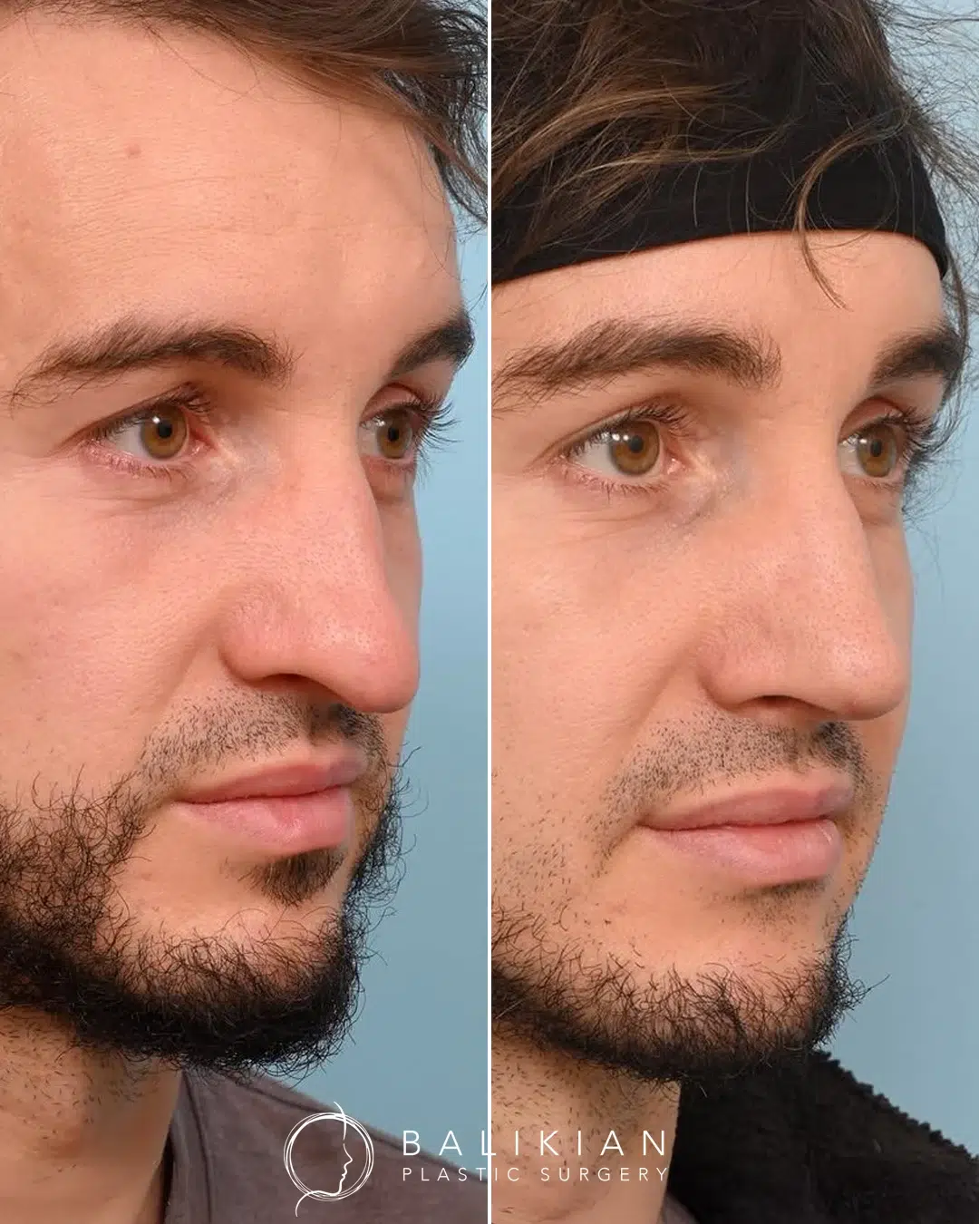 Rhinoplasty before and after, male right oblique view. Bridge reduced and tip balanced to fit facial features. Left is before, right is after.