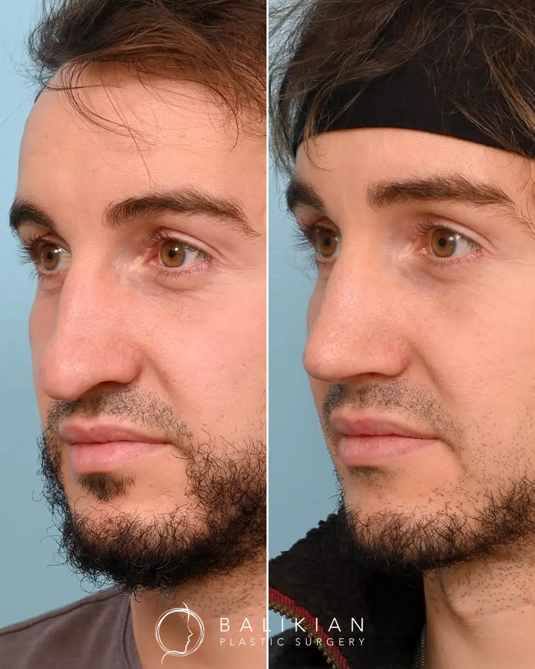 Rhinoplasty before and after, male left oblique view. Subtle hump reduction and tip refinement for a cleaner profile. Left is before, right is after.