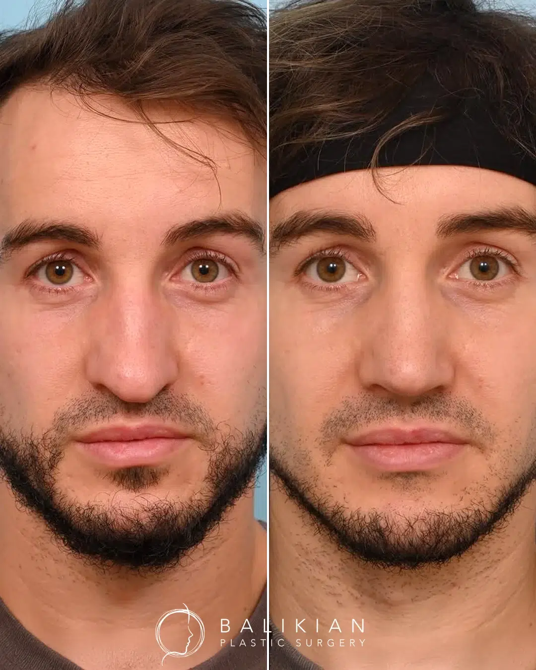 Rhinoplasty before and after, male front view. Straighter bridge and improved tip symmetry. Left is before, right is after.