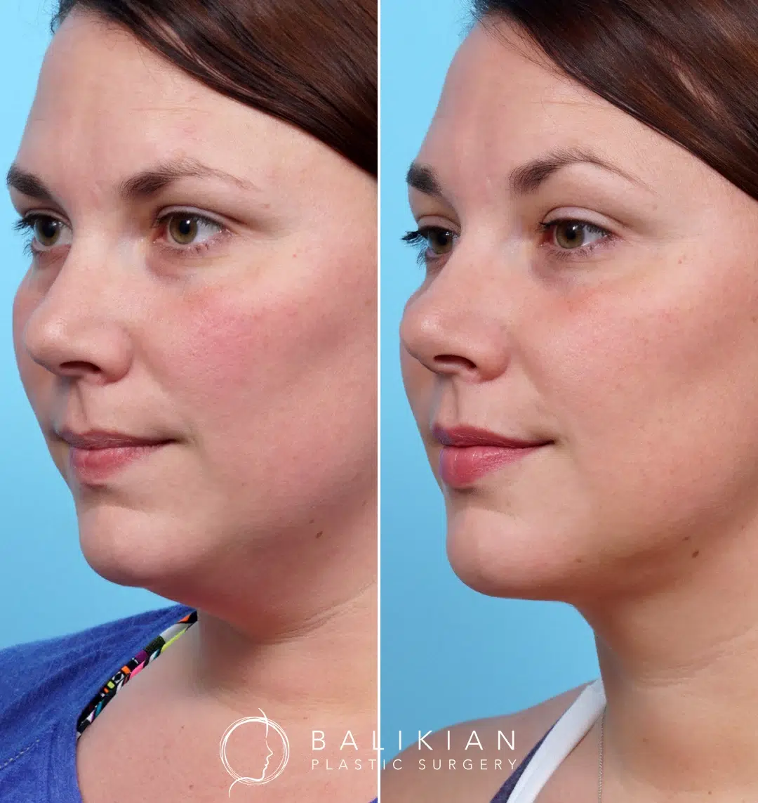 A female patient’s profile view before and after neck liposuction shows a more defined jawline and reduced fullness under the chin.