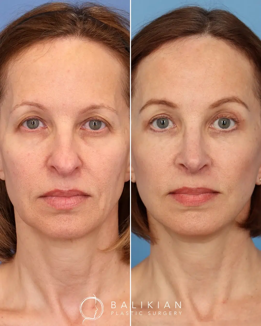 Facelift and neck lift before and after front view of a middle aged woman with softened lines, a tighter neck, and a defined jawline.