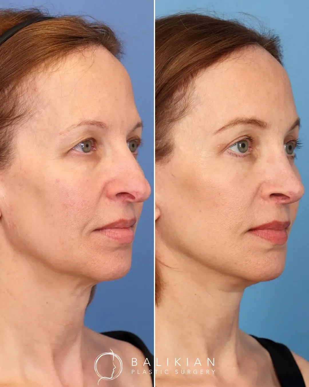 Facelift and neck lift before and after left oblique view showing a smoother neckline, natural cheek lift, and firm jawline.
