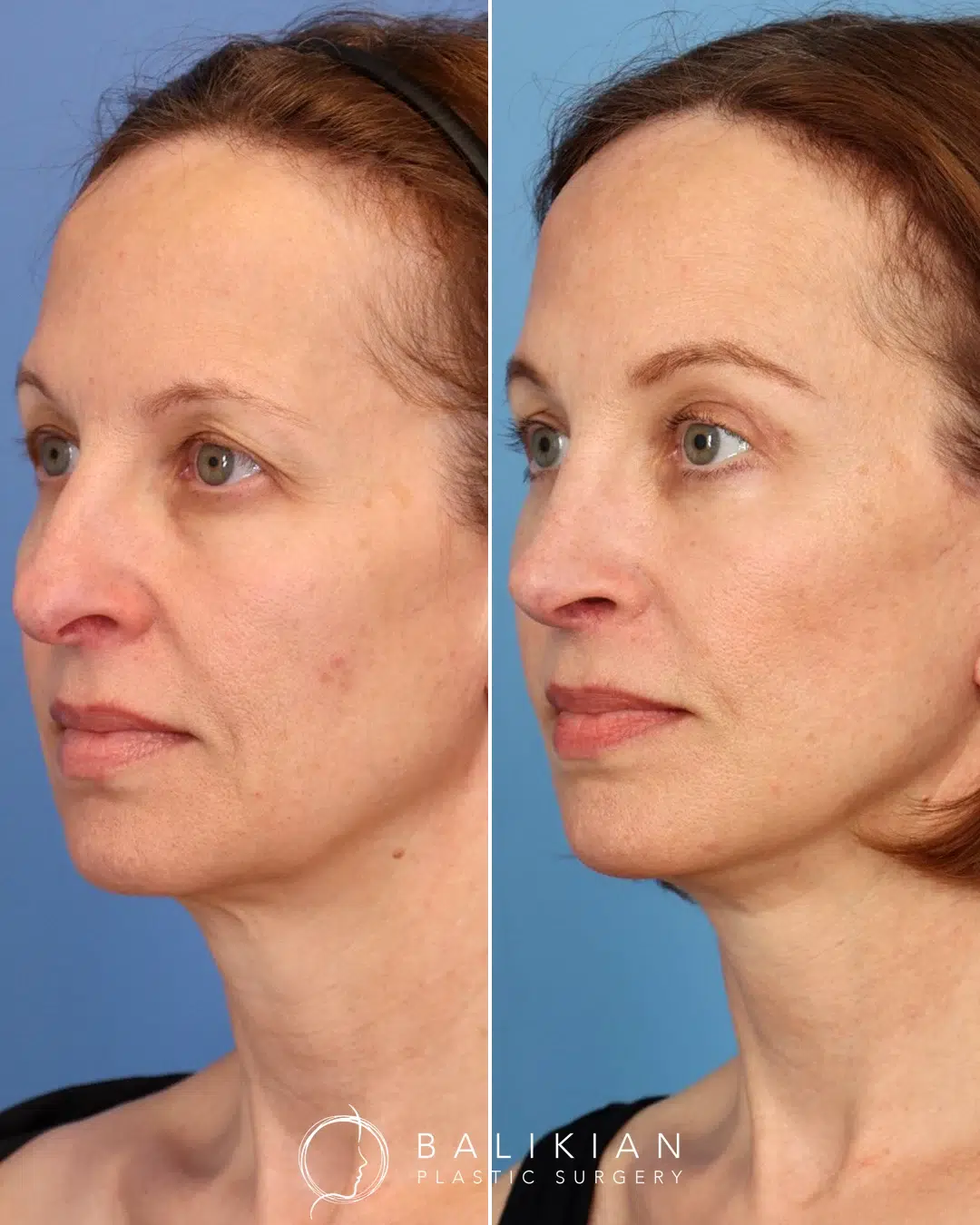 Facelift and neck lift before and after right oblique view with lifted cheeks, sculpted jawline, and reduced sagging around the mouth.