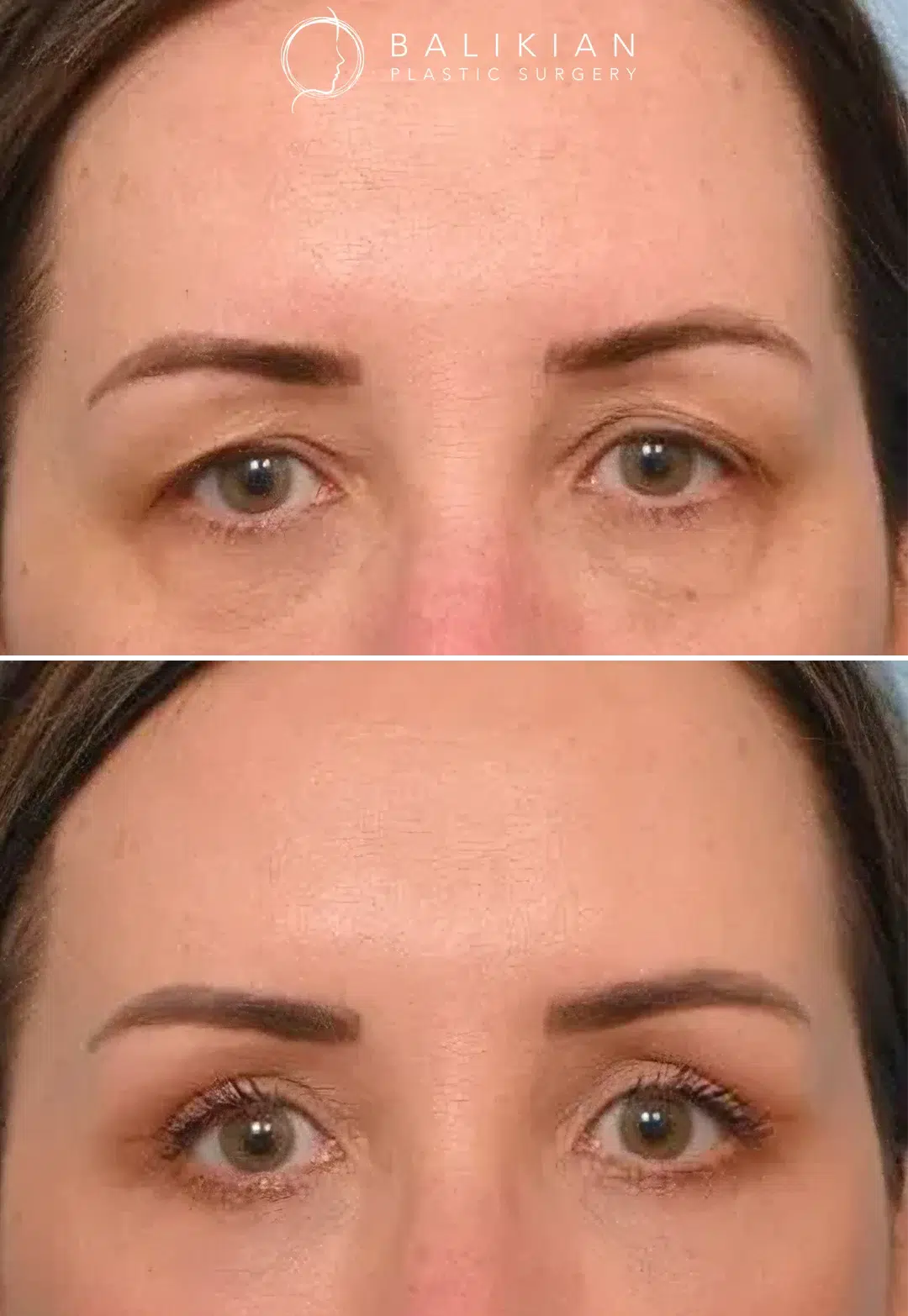 Before and after frontal view of a younger woman after temporal brow lift procedure, revealing a higher brow position and more open eye area.