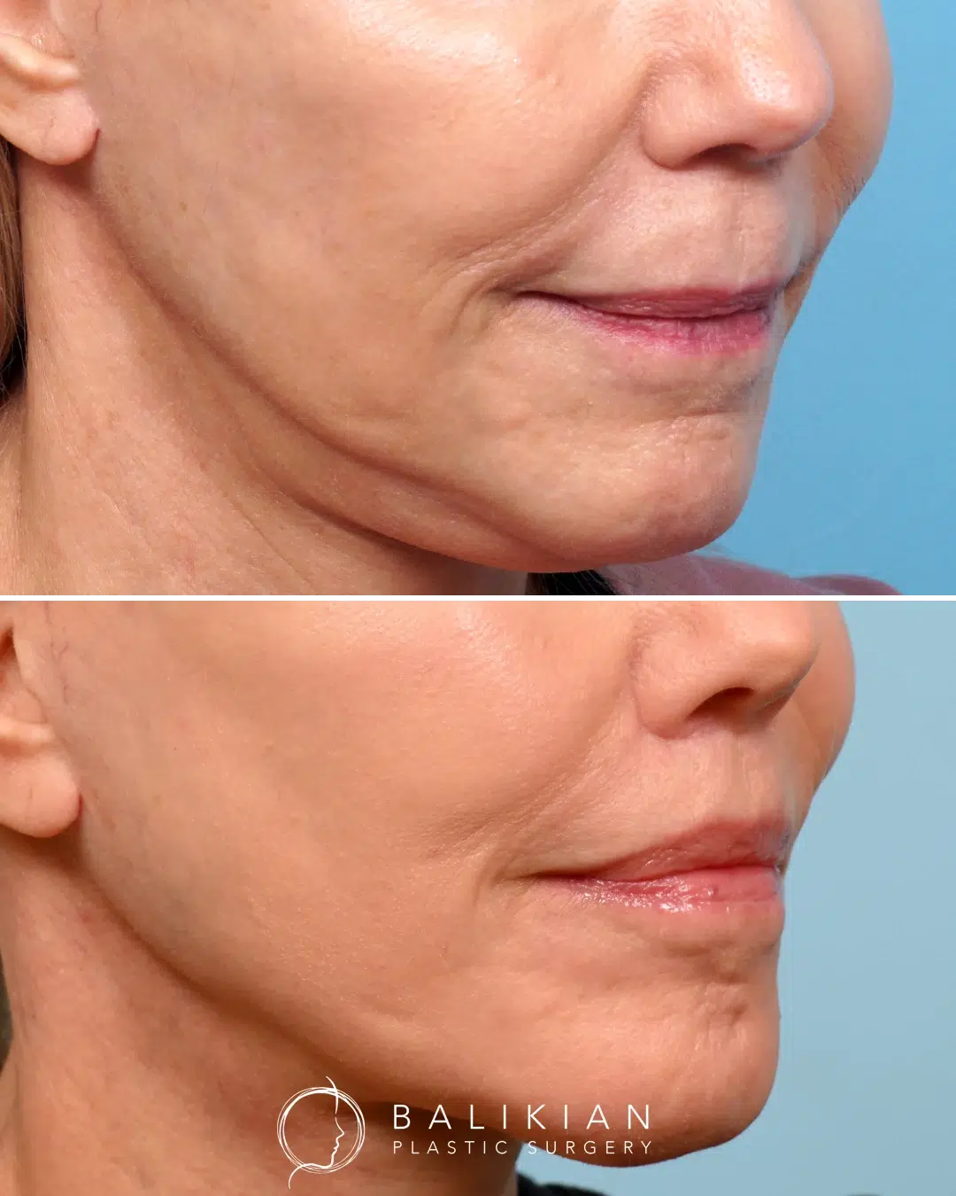 Upper lip lift before and after angled view with softened wrinkles, fuller visible pink lip, and balanced facial proportions.