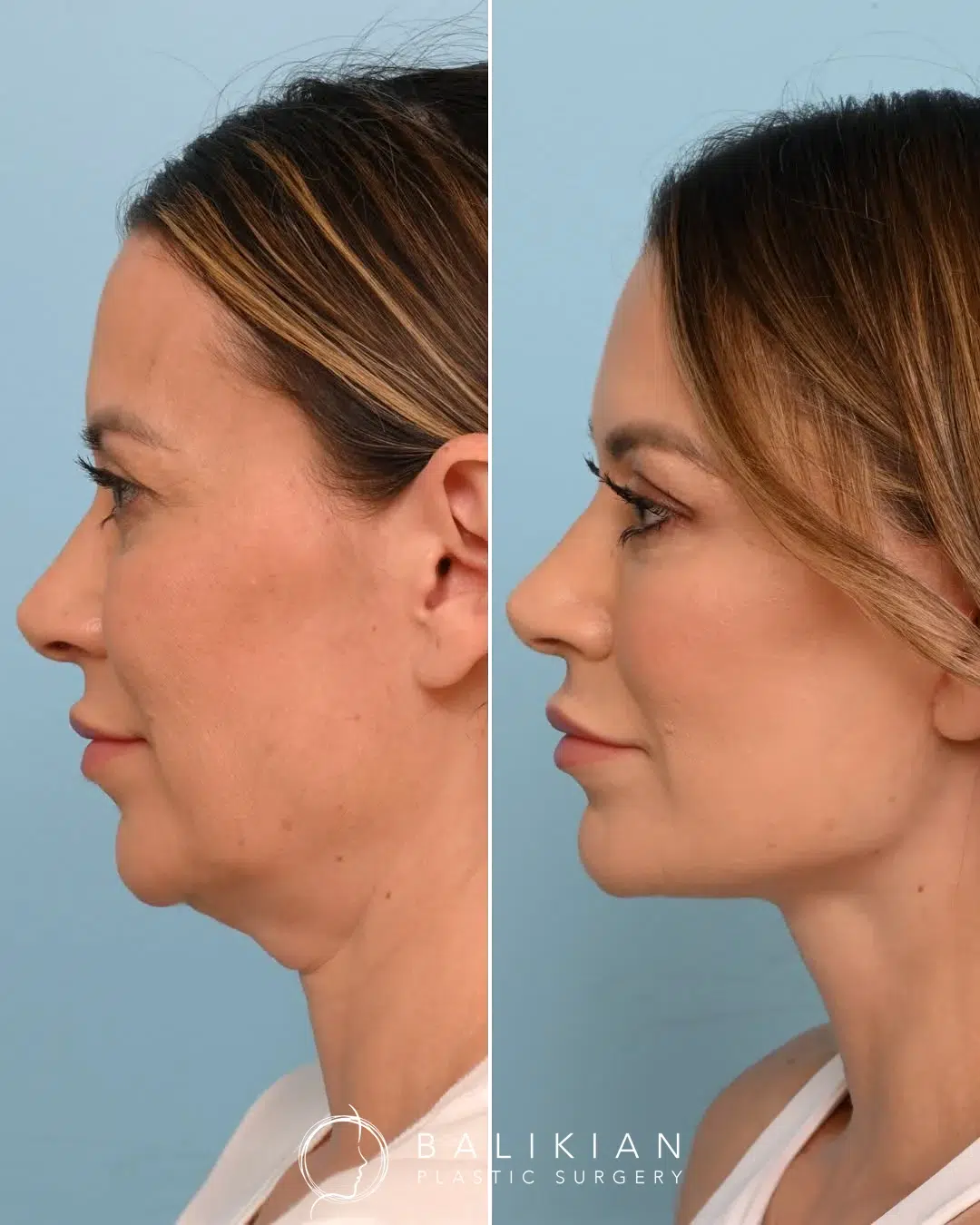 Opposite profile view before and after facelift and neck lift with natural contour restoration.